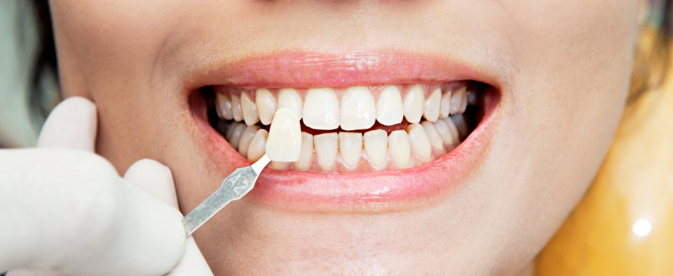 Виниры на зубы – больно ли это и каковы их недостатки?